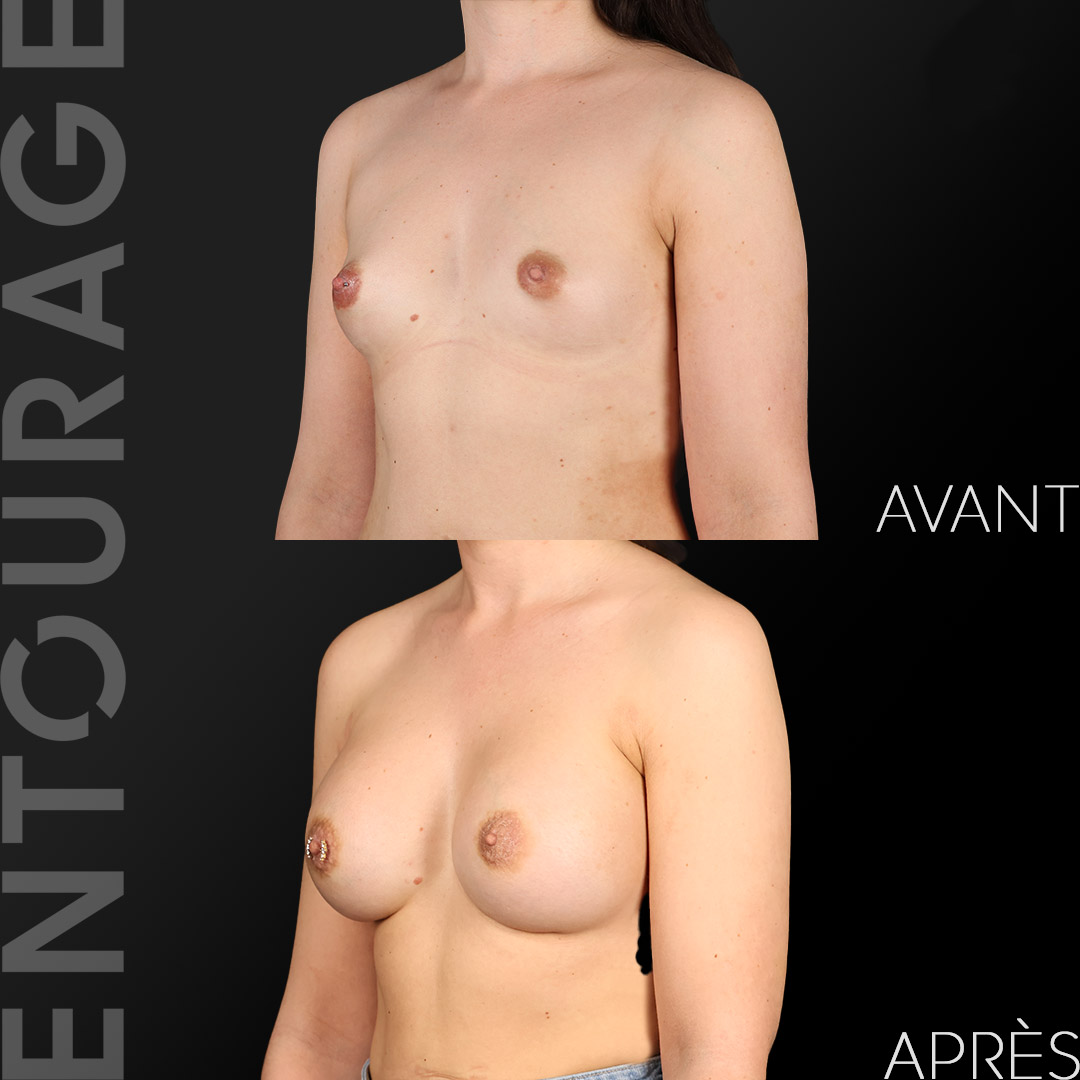 Avant après l'augmentation des seins