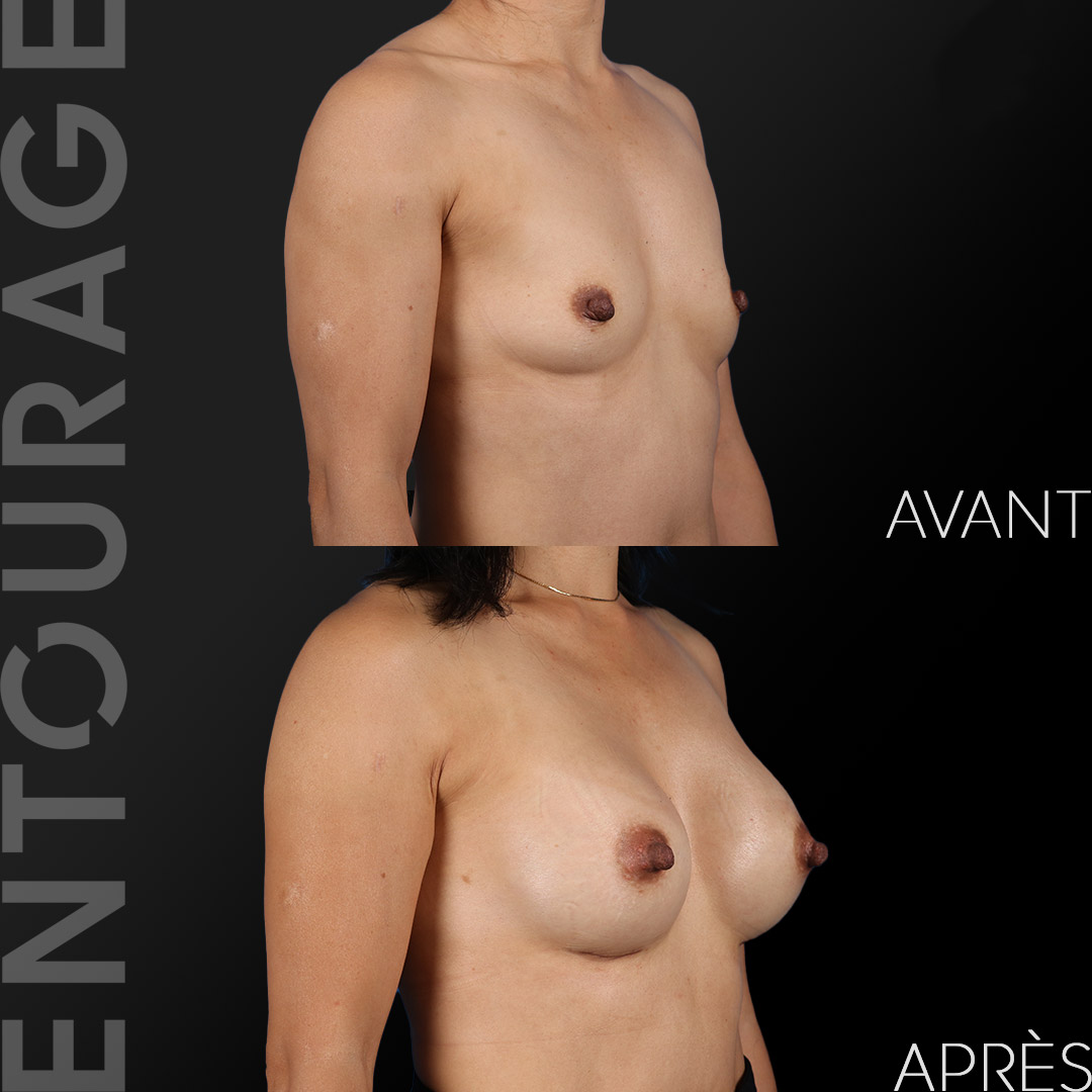 Avant après l'augmentation des seins