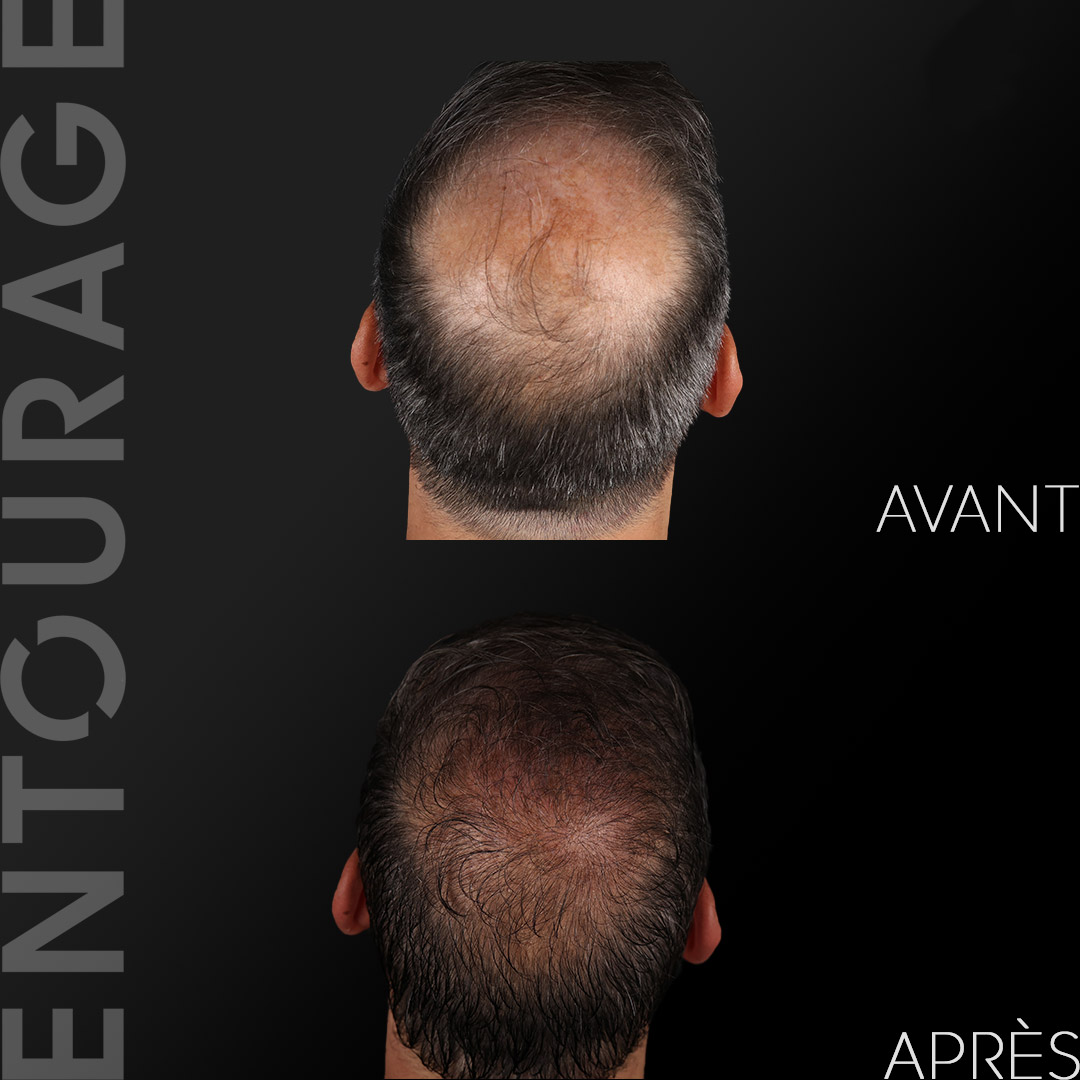 Micro greffe de cheveux, implants capillaire - Lausanne