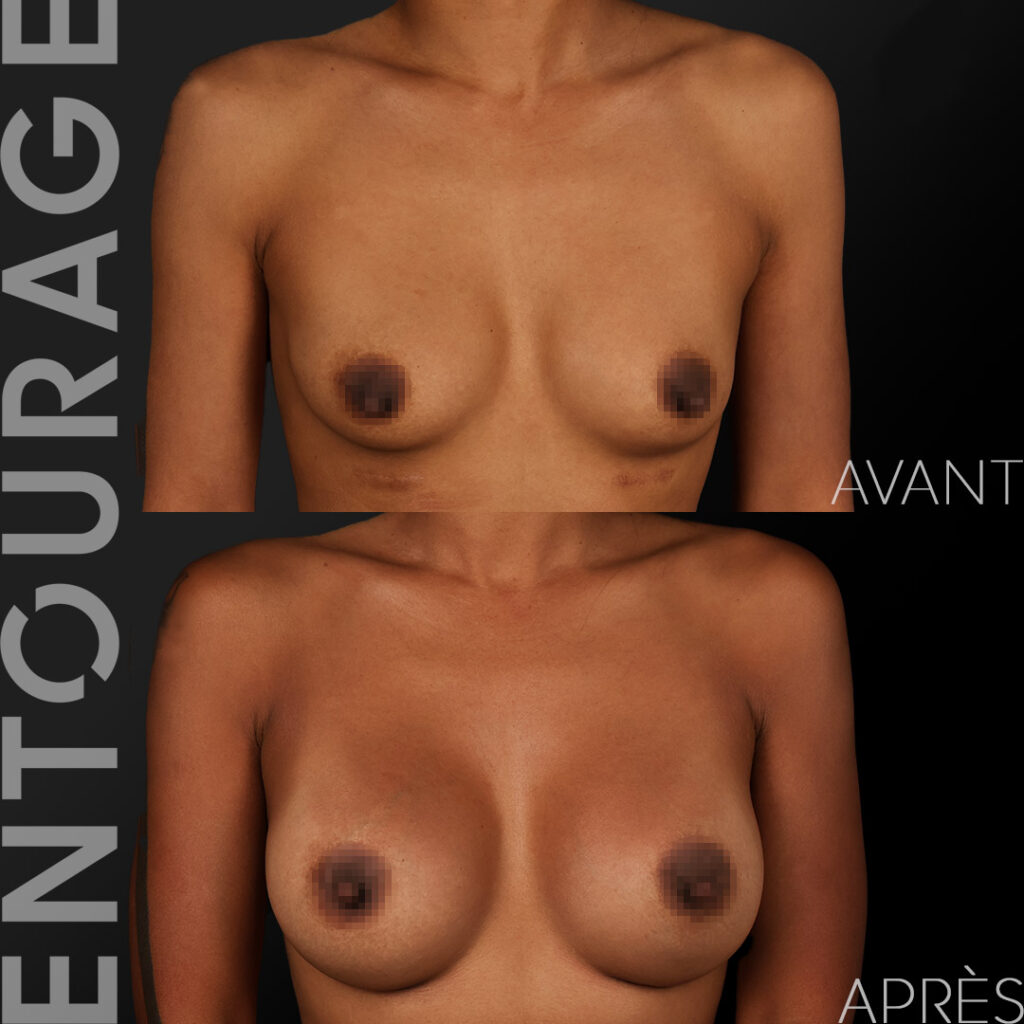 Before and after breast implant replacement